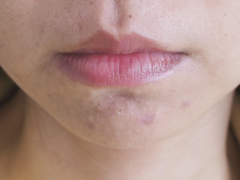 Post-Inflammatory Hyperpigmentation (PIH) - Papilla By Kim Lim