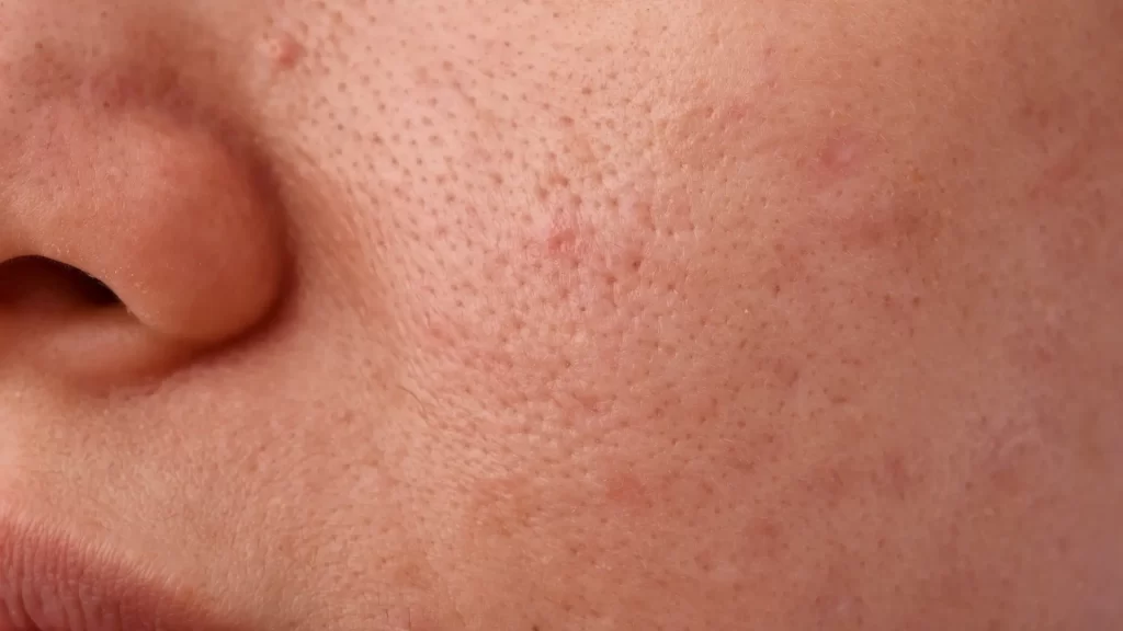 Close-up of enlarged pores on a woman’s face.